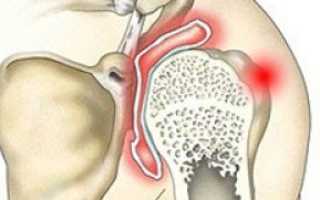 Артрит плечевого сустава симптомы и лечение в домашних условиях