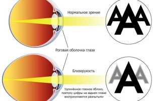 Как вылечить близорукость