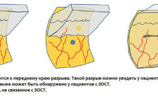 Отслойка сетчатки регматогенная