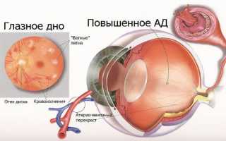 Ангиоспазм сетчатки глаза что это такое