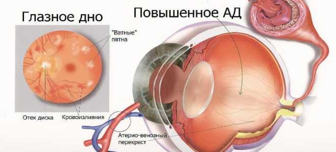 Ангиоспазм сетчатки глаза что это такое