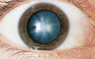 Катаракта глаза лечение