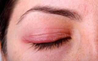 Как проявляется аллергия глаз