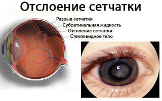 Причины отслоения сетчатки глаза