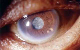 Глазные капли от катаракты
