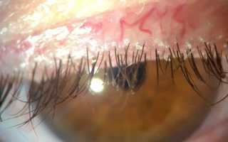 Демодекс глаз лечение
