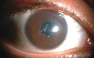 Дистрофия сетчатки глаза что это такое профилактика и лечение
