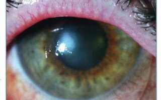 Эрозия роговицы глаза лечение