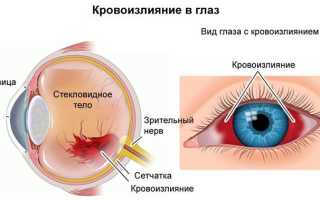 Кровоизлияние в стекловидное тело глаза лечение