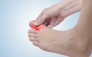 Артрит пальцев ног симптомы и лечение