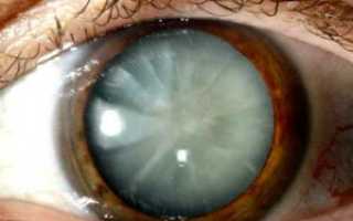 Осложненная катаракта что это такое
