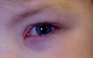 Красный глаз у ребенка и слезится