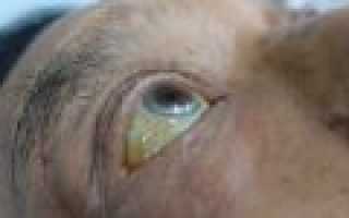 Почему белки глаз желтеют