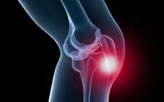 Ревматоидный артрит коленного сустава симптомы и лечение