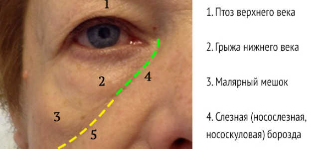 Убрать мешки под глазами косметология