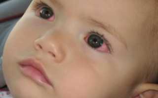 У ребенка красный глаз без гноя