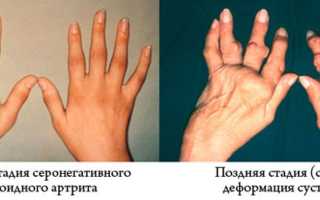 Серонегативный ревматоидный артрит