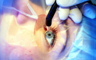 Операция на глаза близорукость
