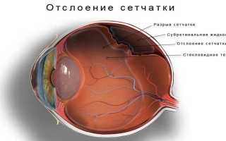 Операция на сетчатке глаза