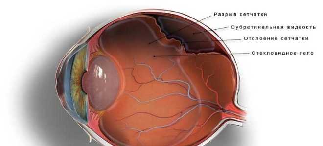 Операция на сетчатке глаза