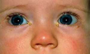 Альбуцид для новорожденных в глаза