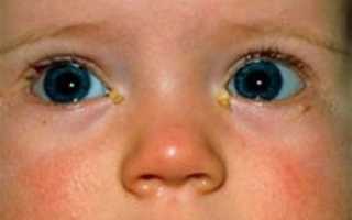 Альбуцид для новорожденных в глаза