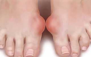 Шишки на ногах у большого пальца причины как лечить