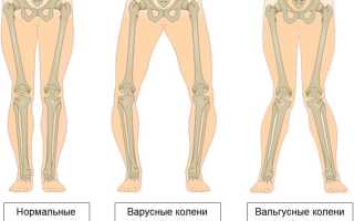 Вальгусная деформация коленных суставов