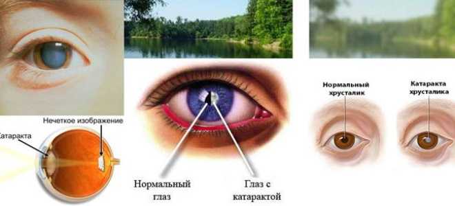 В глазах радужные круги