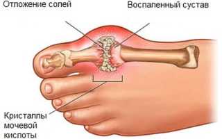 Можно ли вылечить подагру