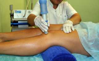 Синовит коленного сустава симптомы лечение