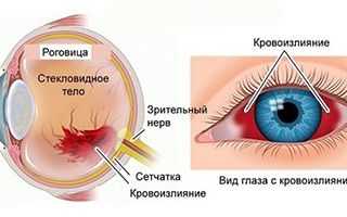 Кровоизлияние в глаз причины и лечение