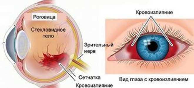 Кровоизлияние в глаз причины и лечение