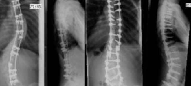 Операция по исправлению сколиоза