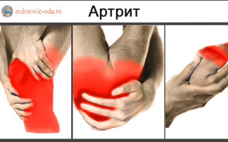 Чем отличается артрит от артроза