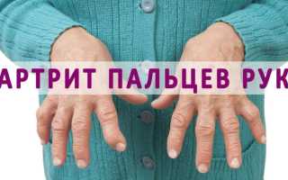 Как лечить ревматоидный артрит кистей рук