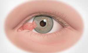 Птеригиум глаза лечение