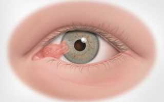 Птеригиум глаза лечение
