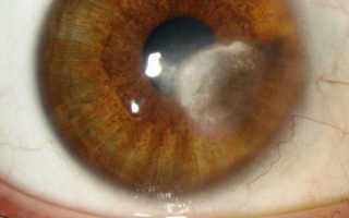 Кератит глаза лечение