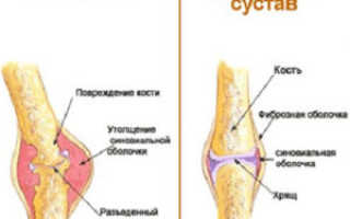 Опухоль коленного сустава