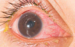Отслоение сетчатки глаза симптомы