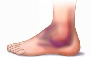 Гематома на ноге после ушиба лечение