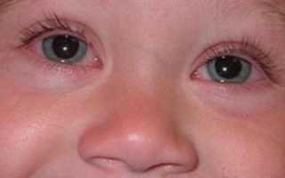 Покраснение у глаза у ребенка