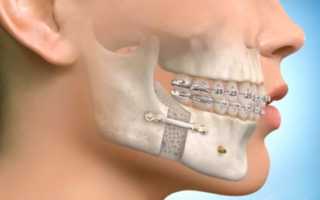 Перелом челюсти симптомы