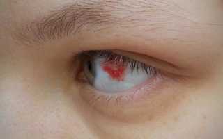 Почему в глазах лопаются капилляры