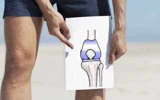 Операция по замене коленного сустава