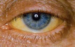 Желтые глаза причины