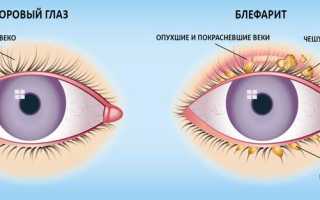 Покраснение век глаз причины и лечение