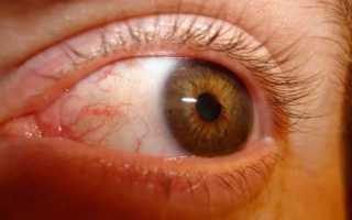 Синдром сухого глаза симптомы и лечение народными средствами