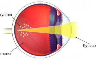 Укрепление сетчатки глаза лазером